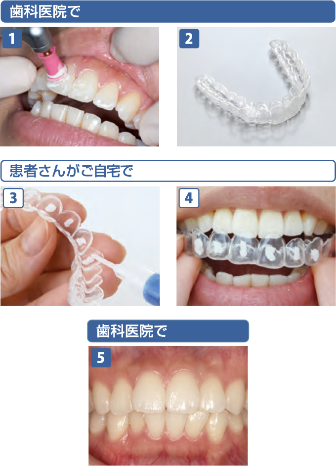 ホワイトニング|北九州市小倉北区のはしもと歯科クリニック